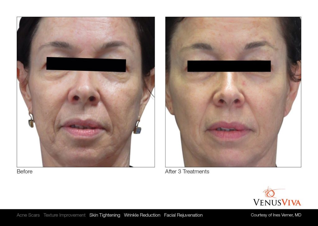 Before and after, Venus Viva Skin Resurfacing