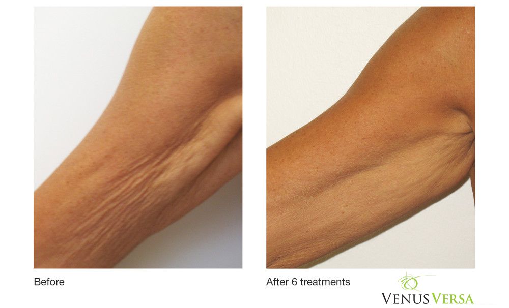Venus Freeze treatment before and after