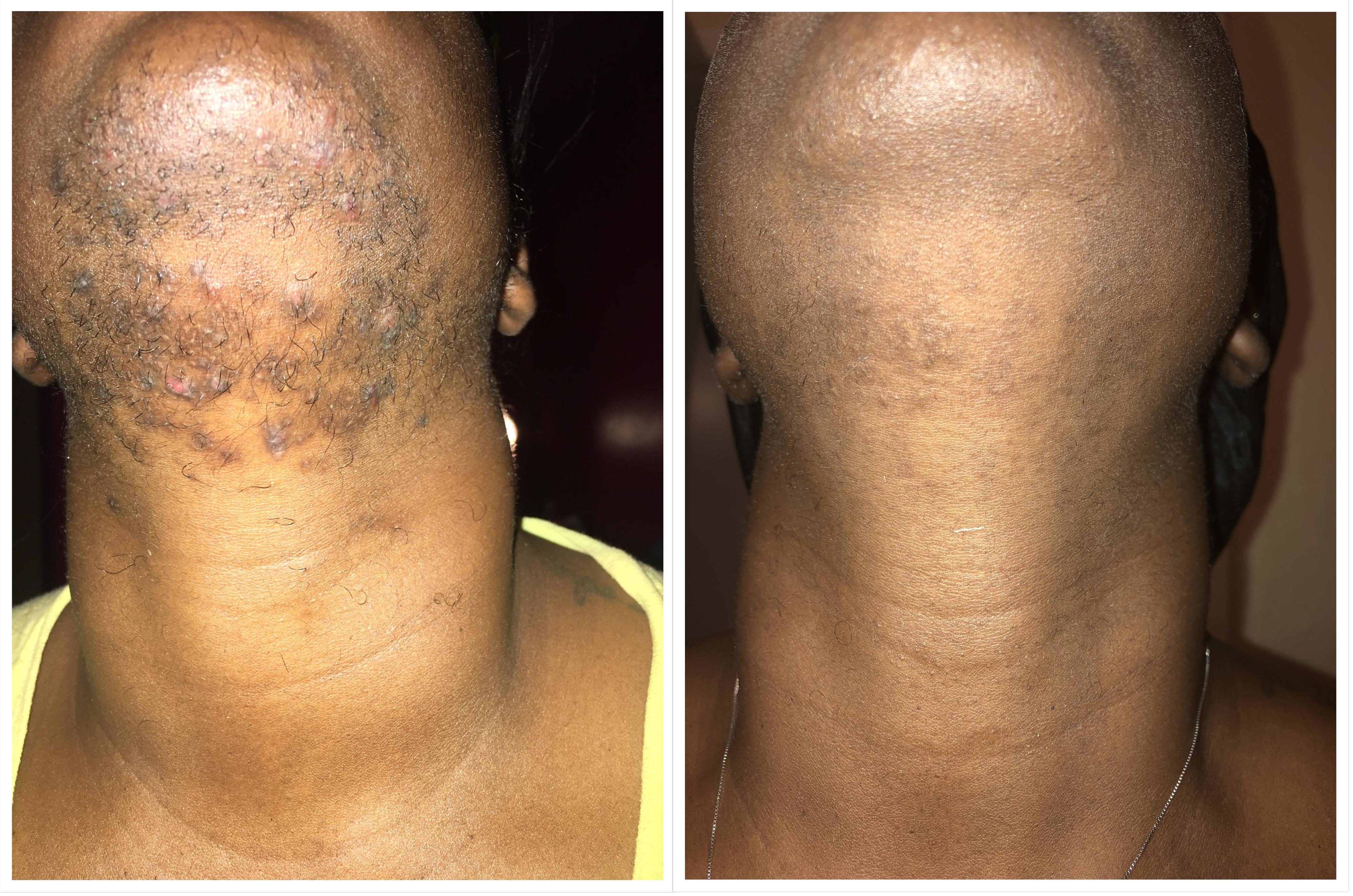 Before and After Laser Hair Removal 